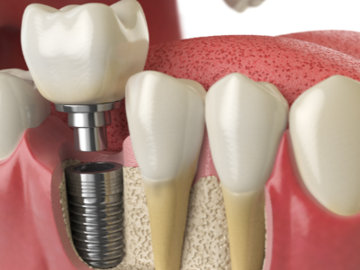 選擇種植牙后要做哪些日常維護？