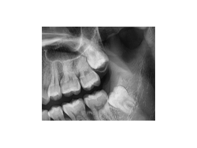 既然「智齒」不宜久留，為什么不能一次性拔掉？