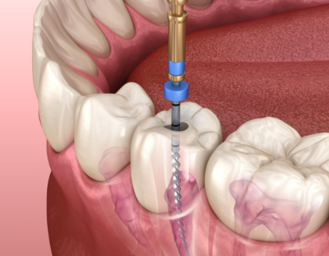 根管治療后的注意事項(xiàng)有哪些？